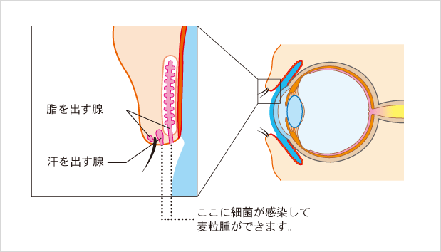 麦粒腫とは